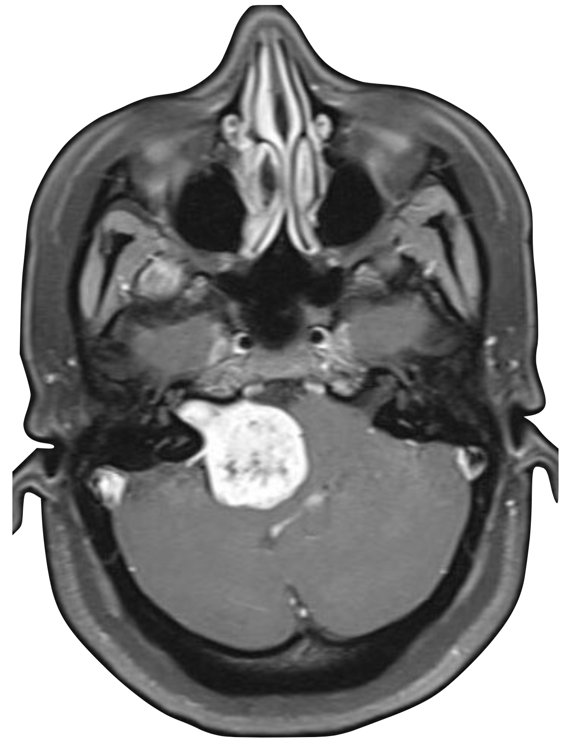 Acoustic Neuroma